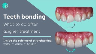 Teeth bonding  what to do after aligner treatment  Inside the science of teeth straightening [upl. by Allmon991]