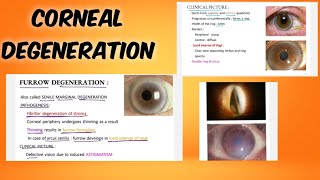 corneal degeneration classification  symptoms  treatment  ophthalmology  English [upl. by Kristos]