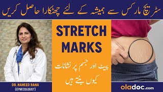 स्ट्रैच मार्क्स को कैसे हटाएं How To Remove Stretch Marks  Sanyasi Ayurveda [upl. by Sidwell357]