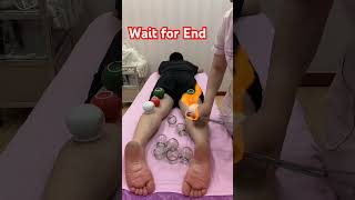 FIRE CUPPING 🔥viral health shortscuppingtherapy firecupping [upl. by Bashuk642]