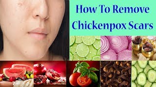 How To Easily Remove Chickenpox Scars And Get Smoothy Skin [upl. by Kumar51]