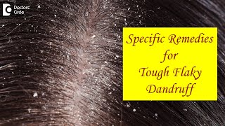 FLAKY SCALP DANDRUFF not cleared by Home Remedies What to do  Dr Amee Daxini  Doctors Circle [upl. by Aniat485]