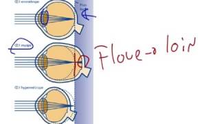 Myopie presbytie et hypermétropie [upl. by Buchbinder]