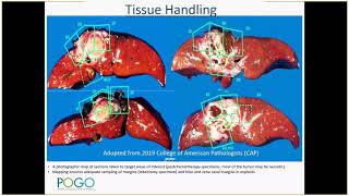 CAP education session Pediatric Hepatoblastoma Dr El Demellawy 2019 [upl. by Bary]