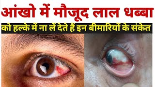 आंख लाल होने का कारण  subconjunctival hemorrhage in hindi  subconjunctival hemorrhage treatment [upl. by Primalia]