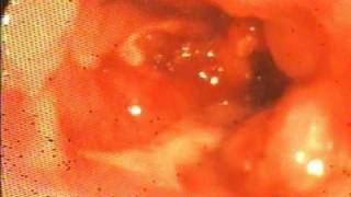 Crohns Disease Lesion of the terminal ileumColonoscopy [upl. by Yecal]