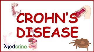 CROHNS DISEASE causespathophysiologyclinical featuresdiagnosis and treatment [upl. by Alegna]