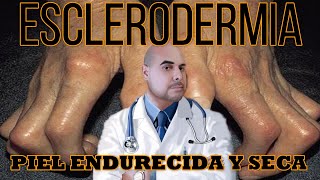 ESCLERODERMIA😑Resumen Total USMLE [upl. by Eidnak]