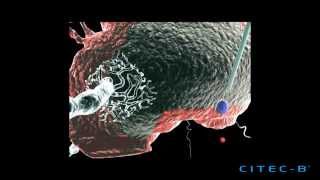 Parkinson 3  Tratamiento de la enfermedad de Parkinson [upl. by Griggs482]