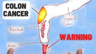 4 Warning Signs of Colon Cancer You Should NEVER Ignore [upl. by Mccowyn]