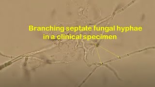 Branched Septate Fungal hyphae in Clinical Specimen [upl. by Aihsemaj]