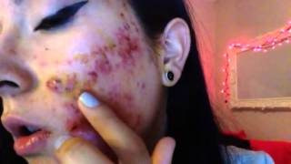 Severe cystic acne accutane week 1 [upl. by Phelips701]