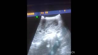 ultrasound video shows chronic cholecystitis [upl. by Isyad]