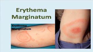 Erythema Marginatum Rash [upl. by Heyra834]