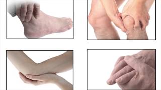 Treatment for Gout [upl. by Orgalim]