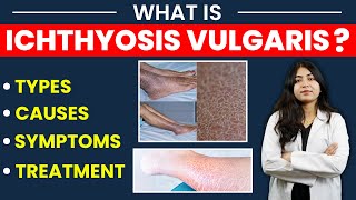 what is Ichthyosis vulgaris  Types causes symptoms amp treatment  रूखी सूखी  फटी हुई त्वचा [upl. by Pederson]