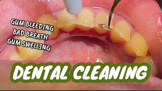 DENTAL CLEANING or ORAL PROPHYLAXIS 🦷🤢  With explanation  Dr Bianca Beley [upl. by Delphina815]