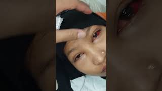 Subconjunctival Hemorrhage due to Vomiting [upl. by Duthie]