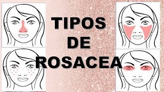 TODO LO QUE DEBES SABER SOBRE LA ROSACEA [upl. by Alyk647]