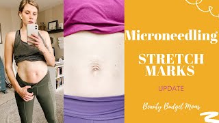 Microneedling STRETCH MARKS [upl. by Nylhsa416]