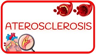 ATEROSCLEROSIS  causas fisiopatología y factores de riesgo [upl. by Aitram]