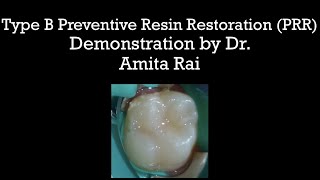 Type B Preventive Resin Restoration PRR Demonstration by Dr Amita Rai [upl. by Aneret826]