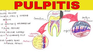 Pulpitis  Pathophysiology Causes amp Types [upl. by Lili]