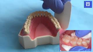 Technique for placing a resin fissure sealant [upl. by Gardell]