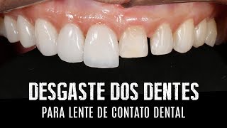 Desgaste dos dentes para lentes de contato dentais e facetas em porcelana [upl. by Eugaet134]