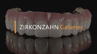 Prettau® 4 Anterior® zirconia on Sintermetall  ZirkonzahnGalleries [upl. by Rheba]