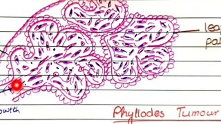 Fibroadenoma And Phyllodes Tumor  Pathology [upl. by Yenial]