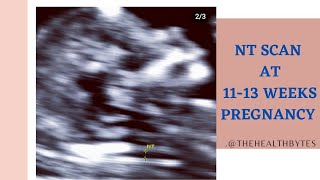 NT scan 11 to 13 weeks scan  explained Tamil version [upl. by Ottinger94]