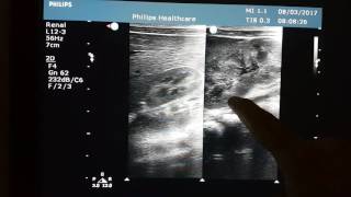 Neonatal Sonography  Right Hypoplastic Kidney [upl. by Knick287]