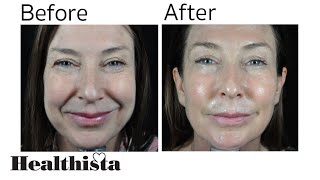 Profhilo Before and After  The AntiAgeing Injectable Moisturiser [upl. by Gwenora]