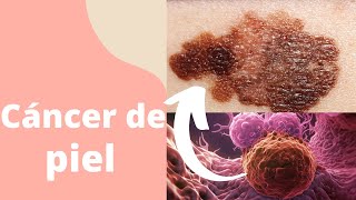 ¿Qué es el cáncer de piel [upl. by North]