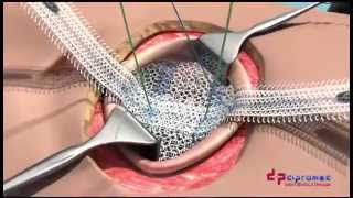 UCMC ClearMesh Composite  Umbilical Hernia Repair [upl. by Bettzel]