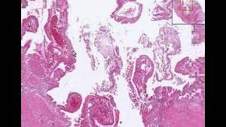 Histopathology GallbladderAcute cholecystitis [upl. by Greenman]