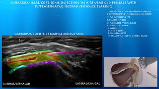 Ultrasound Guided Subdeltoid BursaSubacrominal Injection by probeultrasound [upl. by Dane383]