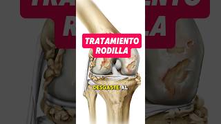 Tratamiento gonartrosis desgaste cartilago rodilla artrosis articulaciones tratamiento dolor [upl. by Marnie911]