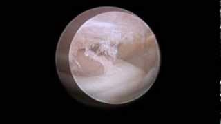 TMJ arthroscopic anatomy [upl. by Leeland]