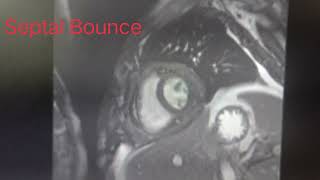 Septal Bounce in Cardiac MRI [upl. by Inalawi]