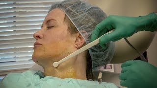 Technique for Lower Face and Neck Tightening With FaceTite [upl. by Beverlie]