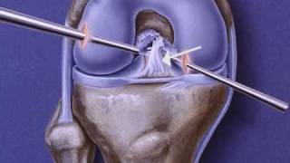 Anterior Cruciate Ligament ACL Repair [upl. by Tomi]