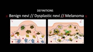 Introduction to Skin Cancer 3 Overview of Nevi and Melanoma [upl. by Sylvester733]