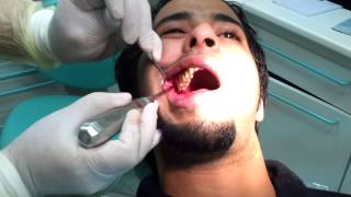 Third molar Extraction wisdom tooth [upl. by Quigley]