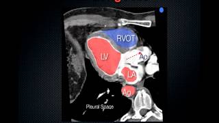 FATE Exam Focused Assessed Transthoracic Echo [upl. by Akital]