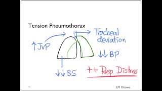 Pneumothorax Part 1 [upl. by Zanas]