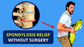 Spondylosis Treatment Without Surgery 🔥 Spondylolisthesis Causes [upl. by Jonah958]