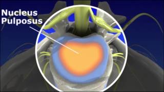 Herniated Disc  Pain Management [upl. by Braden351]