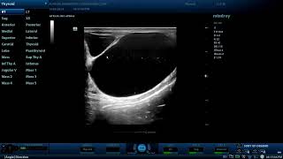 Multiple Epididymal cysts  Diagnostic ultrasound cases [upl. by Ueihtam]